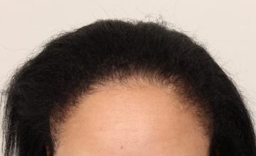 DR. DORIN -   Female hairline FUT result -  2500+ grafts