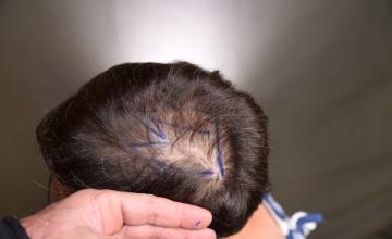 Dr. Arocha - 2000 graft FUE Crown Transplant