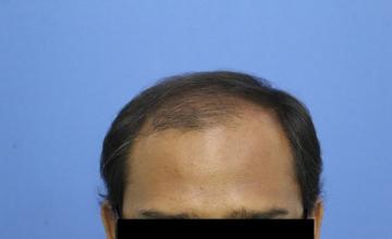 2200 Grafts Bio-FUE Hair Transplant  Result | AK Clinics