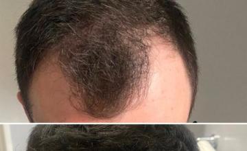 2679 grafts / Dr Gür / Fuecapilar - my experience