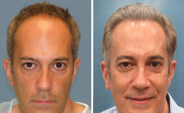 Norwood 4A 2,318 and 1,254 Grafts FUT - Dr. Robert Bernstein