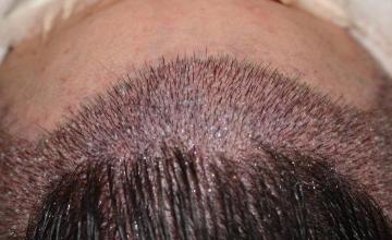 Raymond Konior, MD | Chicago Hair Institute | 3024 Graft Female Hairline Restoration