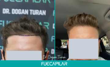 Dr. Turan - FUECAPILAR Clinic, Diffuse thinning across the entire scalp, 2430 grafts
