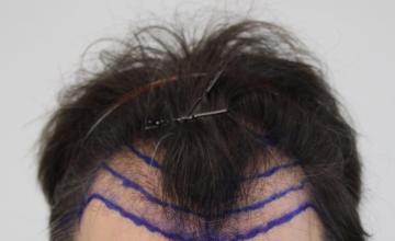 Dr Rahal - 2862 Grafts - FUE