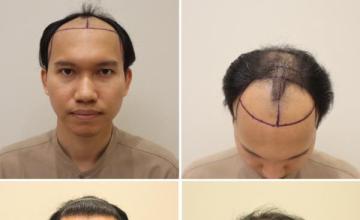 Dr Prapote - FUT technique 1 year result , Hair Restore by DHT Clinic