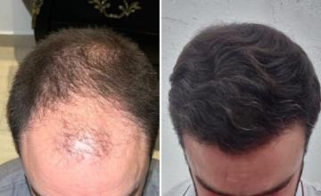 Dr. Pittella - 6744 grafts - 36 years old