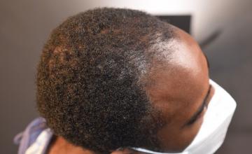 Dr. Arocha | 1500 FUE on an African American Patient | 4 Month Results