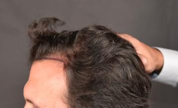 Dr. Arocha | Small Procedure - Big Result