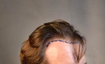 Dr. Arocha | 2000 graft FUT+PRP | 4 Month Results