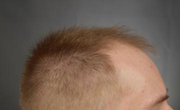 Dr. Arocha | 2500 graft FUE on fine hair