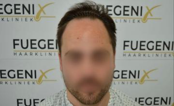 Dr. Munib Ahmad - 2540g - The Hairline That You Dream Of - FueGenix - The Netherlands