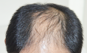 Dr. Suneet Soni - 4250 FUT + FUE Grafts, NW VI