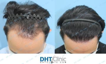 Dr. Damkerng Pathomvanich (DHT Clinic) / FUE 2,290 grafts to the frontal hairline in an Asian Male