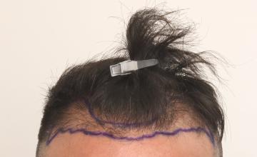 Dr. Robert Dorin ~ Patient submission ~ 1763 graft Hairline FUE
