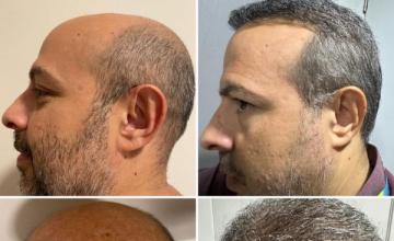 Impossible Norwood 7 -Dr. Pittella - 11.026 grafts - 45 years old.