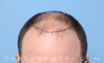 35 Year Old Male with Class VI Hair Loss by Dr. Parsa Mohebi