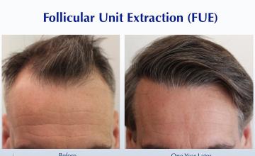 Broadway Bound Hairline (2537 grafts): Carlos K. Wesley, M.D. (NYC & LA)