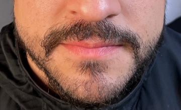 Dr. Arocha - FUE Beard Transplant | 1200 Grafts - early growth