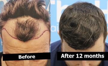 Dr Arshad / The Hair Dr Clinic (Leeds,UK) - 2873 grafts by FUE. 12 month follow up images.
