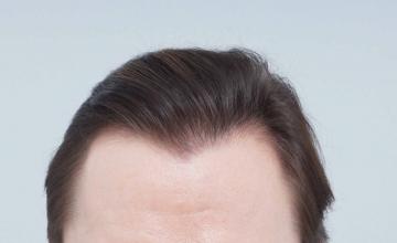 Dr B Farjo 1400g FUE Hairline