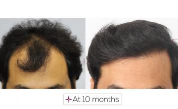 10 Months Hair Transplant results | Grafts 2560, Norwood Grade 4A @Eugenix Hair Sciences