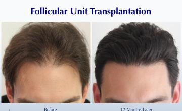 A "Soft Density" in Hairline (2368 FUT grafts): Carlos K. Wesley, M.D. (NYC & LA)