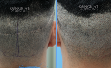 Dr. Kongkiat Laorwong, MD, FISHRS,  FUE 1540 grafts hairline