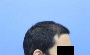 2500 Grafts FUE Hair Transplant | 12 Months Post Op Results