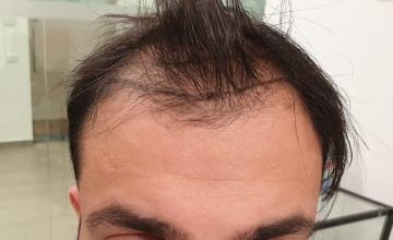 Hair Transplant Result After 27 Months – 3200 Grafts – HDC Hair Clinic