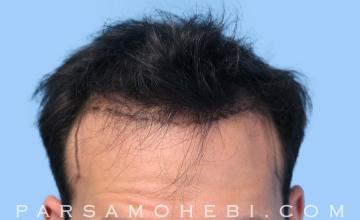 31 Year Old Male with Class III-V Hair Loss by Dr. Parsa Mohebi