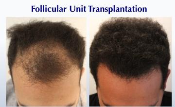 Bring My Big Curly Hair Back! (2312 FUT grafts): Carlos K. Wesley, M.D. (NYC & LA)