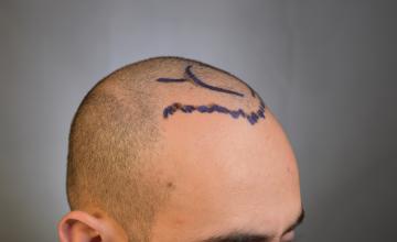Dr. Arocha | 2000 Graft FUE | 3 Year Results
