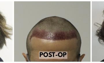 FUE Hair Transplant - Dr. Rahal - 1835 Grafts (4201 Hairs)