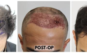 FUE Hair Transplant - 2554 Grafts (5597 Hairs) - Dr. Rahal