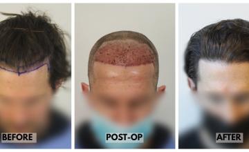 3181 Grafts (6789 Hairs) - FUE Hair Transplant - Dr. Rahal