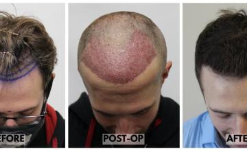 Revitalizing Radiance: Dr. Rahal's Remarkable FUE Transformation - 2982 Grafts, 5925 Hairs