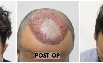 FUE Hairline Restoration - Rahal Hair Transplant - 2554 Grafts (5597 Hairs)