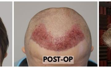 Impressive FUE Hair Transplant Results with Dr. Rahal - 2435 Grafts