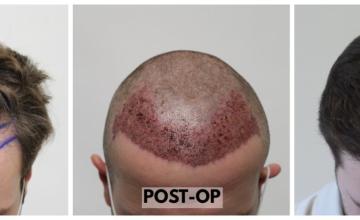 FUE Hair Transplant - 2660 Grafts (5593 Hairs) - Dr. Rahal