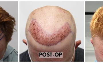 FUE Hair Transplant - Dr. Rahal - 2500 Grafts (4741 Hairs)