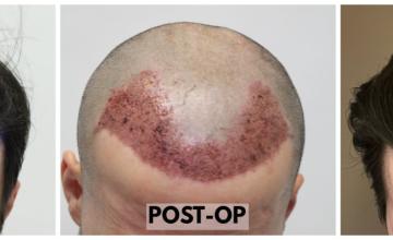 FUE Hair Transplant - 2542 Grafts (5687 Hairs) - Dr. Rahal