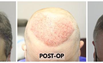 3000 Grafts (6229 Hairs) - FUE Hair Transplant - Dr. Rahal