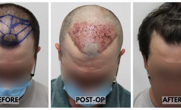 3010 Grafts (6403 Hairs) - FUE Hair Transplant - Dr. Rahal