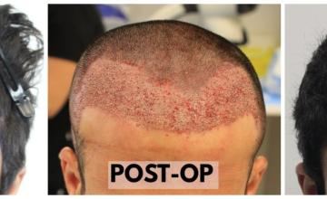 2212 Grafts (5669 Hairs) - FUE Hair Transplant - Dr. Rahal (Toronto, Canada)