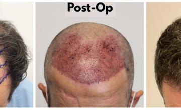 3025 Grafts (6156 Hairs) - FUE Hair Transplant - Dr. Rahal
