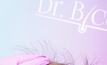 Ozlem Bicer MD-3850 Grafts FUE 9- 12.Months