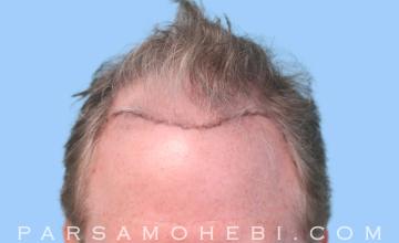 57 Year Old Male with Class IV Hair Loss by Dr. Parsa Mohebi