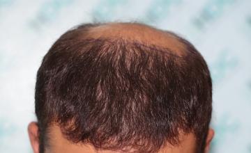 Result of 6800 FUE grafts in two sessions – 7 months after 2md Session – Dr Maras – HDC Hair Clinic