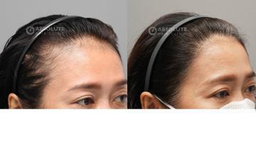 Dr. Kongkiat Laorwong, MD, FISHRS, female hairline FUE 2000 grafts, 12 months post op