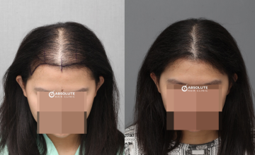 Dr. Kongkiat Laorwong, MD, FISHRS,  Female strip FUT 4200 grafts, 1 year post op.